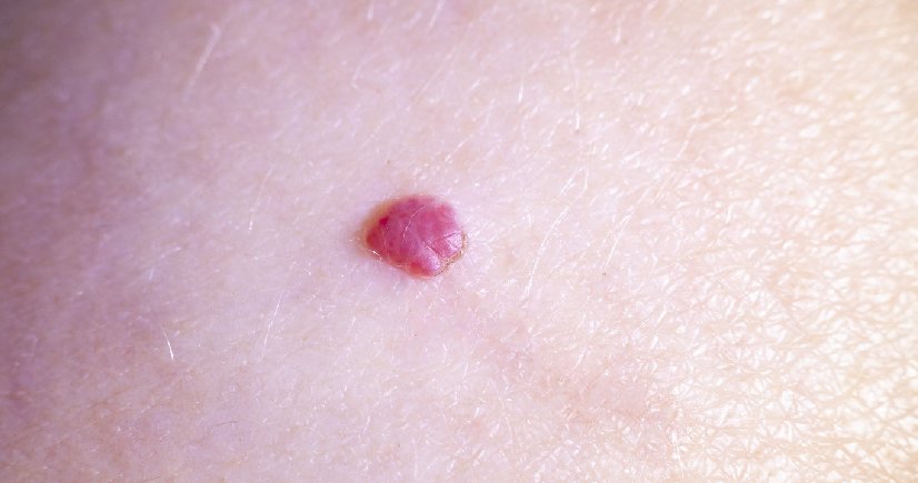 Mole removal treatment in bangalore